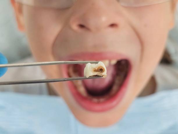 Best Emergency Treatment for Toothache in Union, MS